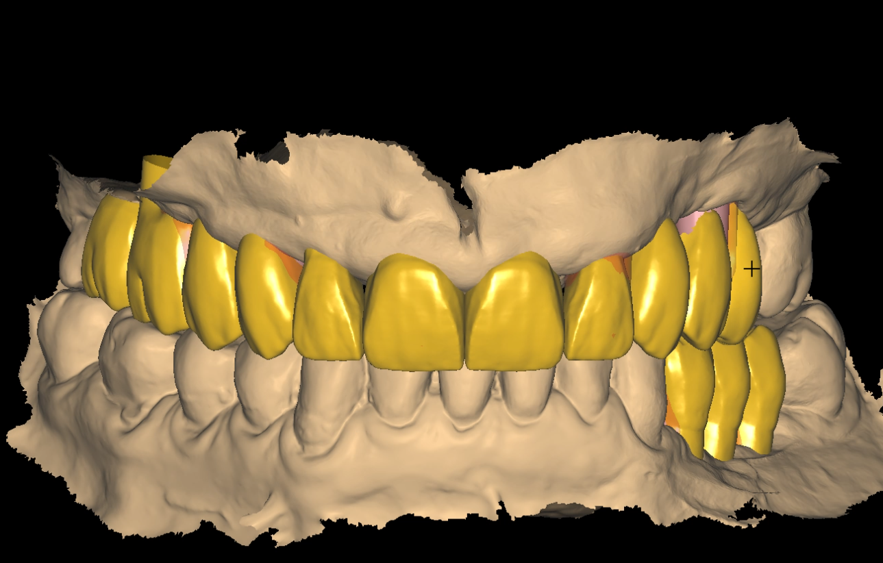 temporary crowns on implant model cast