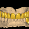 Full Anatomic and temporary crowns