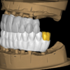 Full Anatomic and temporary crowns